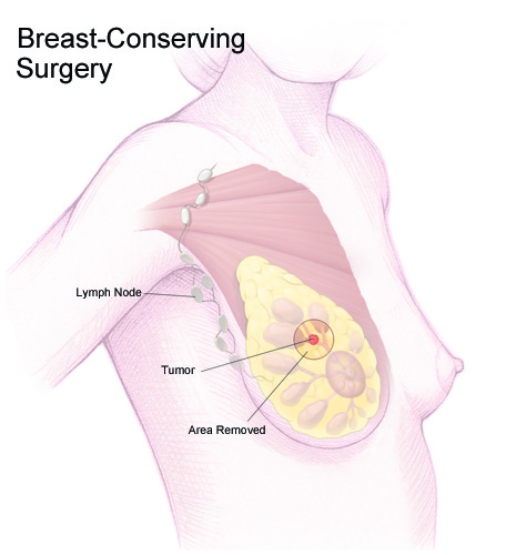 Breast Conserving Surgery