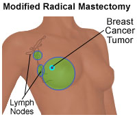 Modified Radical Mastectomy