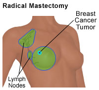 Radical Mastectomy